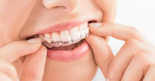 The Top Reasons Why You Should Only Seek Invisalign Treatment with an  Orthodontist - Somerville Orthodontics