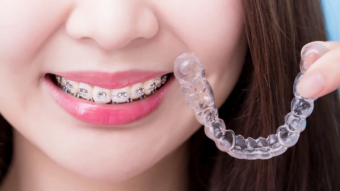 SEO Blog Invis and Braces